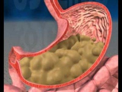 胃酸过多吃什么好  引起胃酸的原因是什么